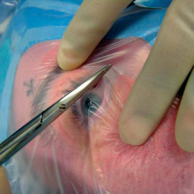 Οφθαλμικό Formable Molder μίας χρήσης αποστειρωμένο χειρουργικό Drapes με τον κάτοχο καλωδίων